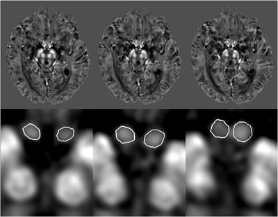 Susceptibility and Volume Measures of the Mammillary Bodies Between Mild Cognitively Impaired Patients and Healthy Controls